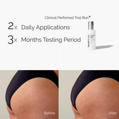 Stretch Marks Smoothening BodyOil™